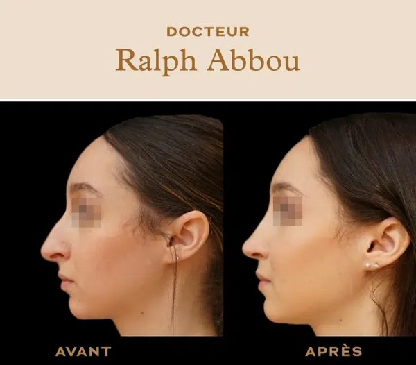 Rhinoplastie ultrasonique à paris : une métamorphose en douceur